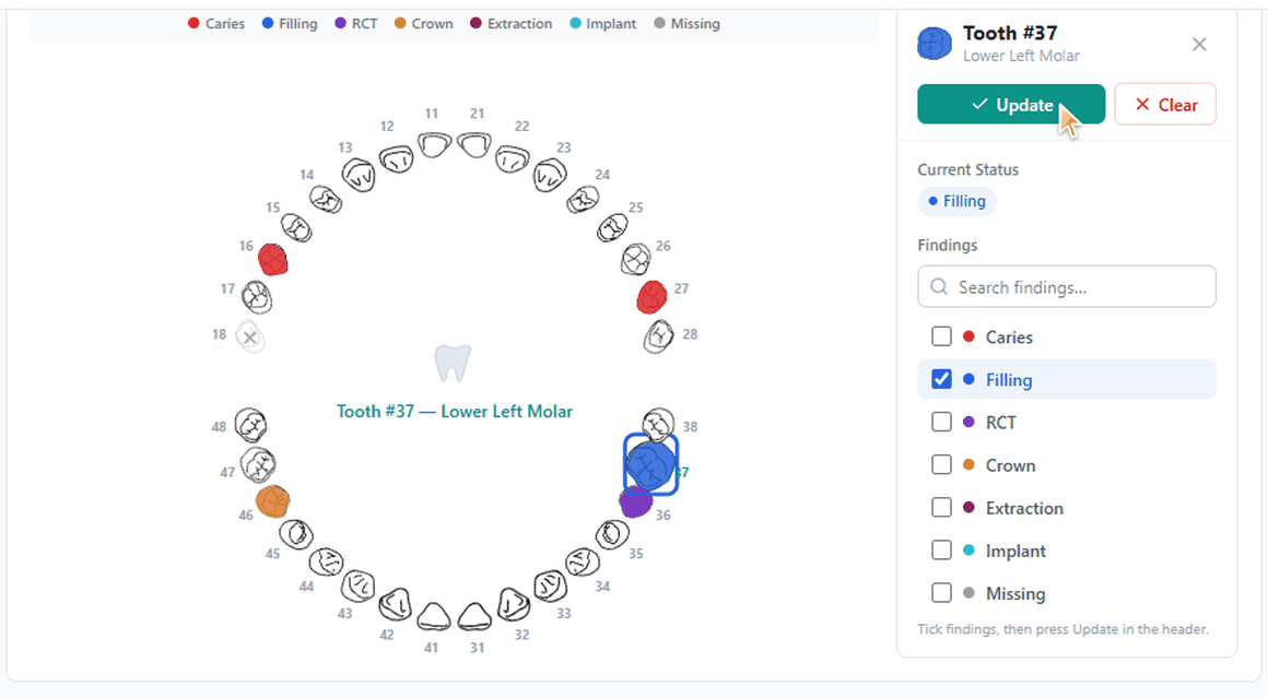 Dentrah odontogram screen: a 32-tooth dental chart with caries, filling, RCT, crown and missing findings marked per tooth